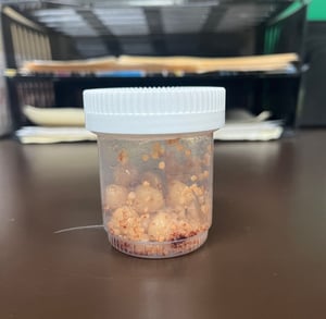Bladder stones removed from pet